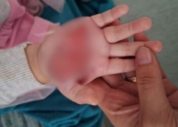 TORTURA | Madrasta é suspeita de queimar enteada de 2 anos como forma de punição