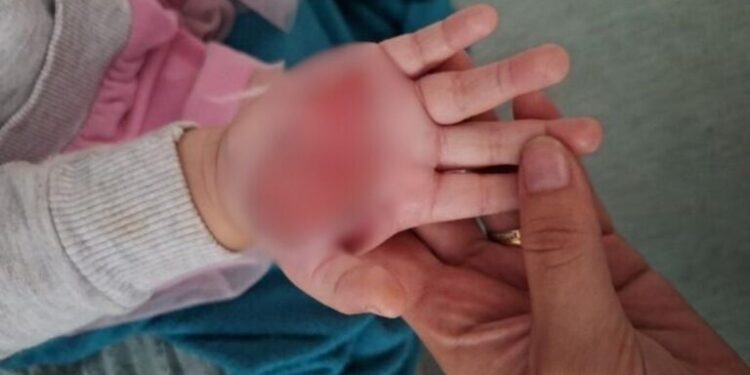 TORTURA | Madrasta é suspeita de queimar enteada de 2 anos como forma de punição