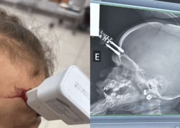 Bebê de 1 ano sofre acidente doméstico com carregador e precisará de acompanhamento neurológico contínuo