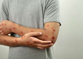 Minas Gerais confirma três casos de mpox em 2026