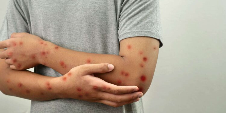 Minas Gerais confirma três casos de mpox em 2026