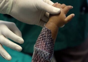Brasil terá primeira fábrica em larga escala de curativo feito de pele de tilápia