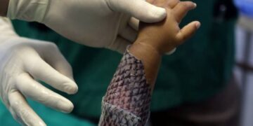 Brasil terá primeira fábrica em larga escala de curativo feito de pele de tilápia
