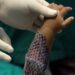 Brasil terá primeira fábrica em larga escala de curativo feito de pele de tilápia